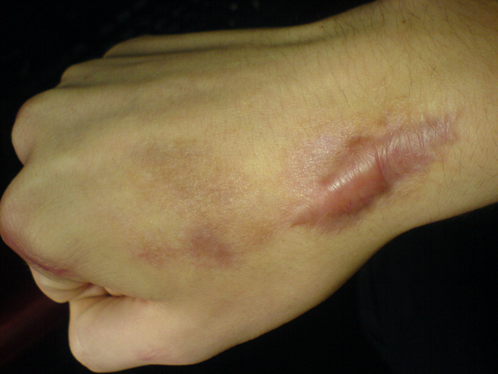 <a href="https://en.wikipedia.org/wiki/Keloid#/media/File:Keloid.jpg" target="_blank" rel="nofollow noopener">Фото: Michael Rodger</a> 