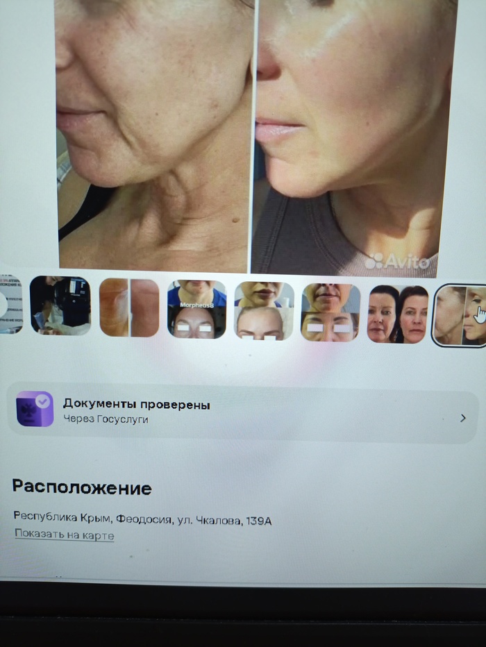 Микроигольчатый рф